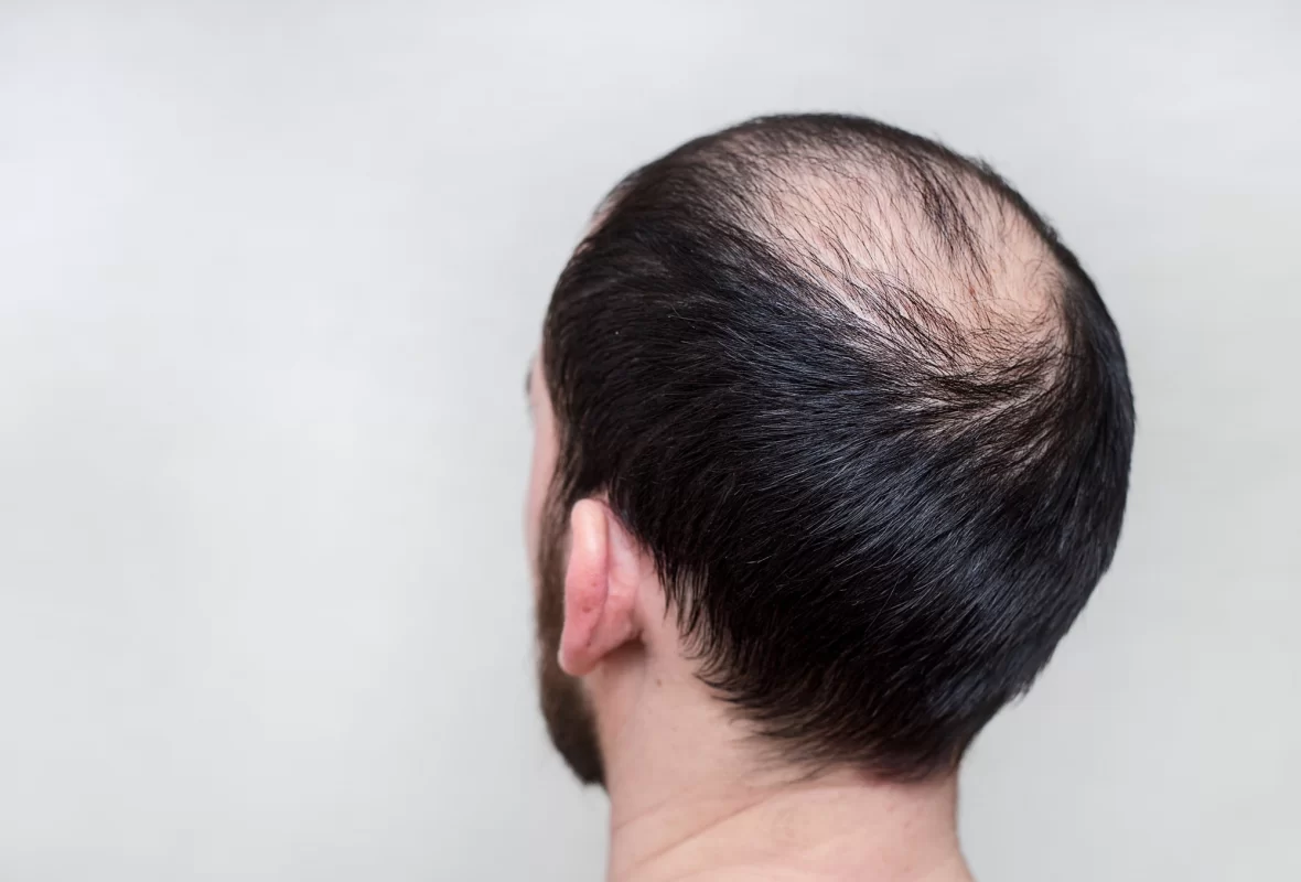 Balding in Men