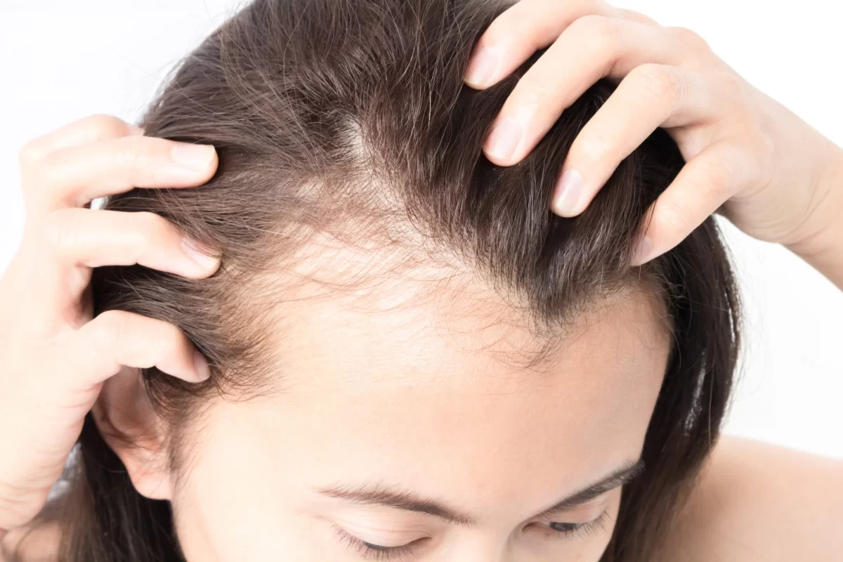 Hormonal Hair Loss