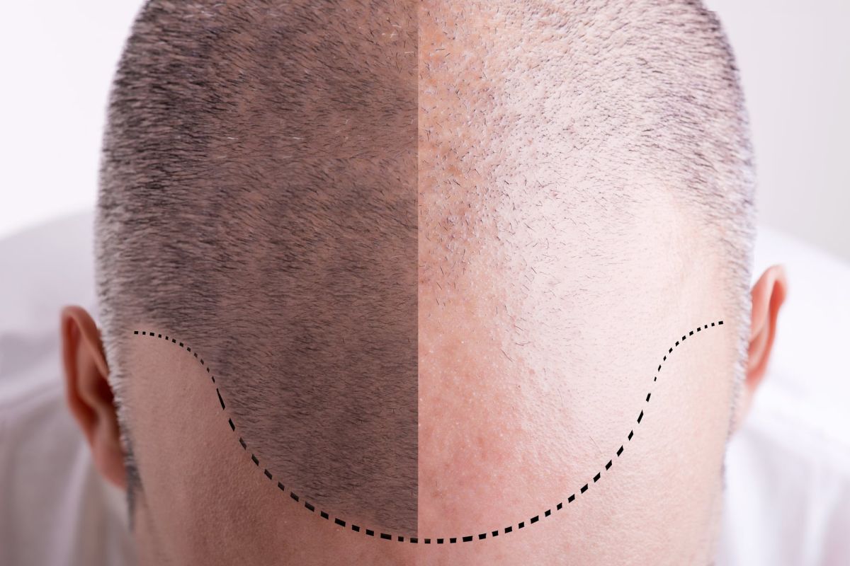 Close-up view of an individual’s head; the left side has close-cropped dark hair, while on the right side the hairline has receded from the person’s forehead and is thinning considerably.