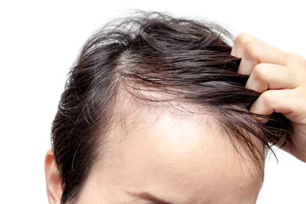 thinning hair signs
